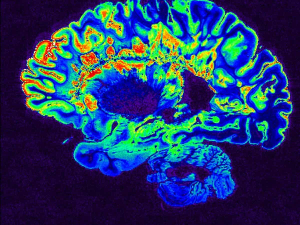 Σκλήρυνση κατά πλάκας: Επιστήμονες εντόπισαν δύο νέους υποτύπους της νόσου