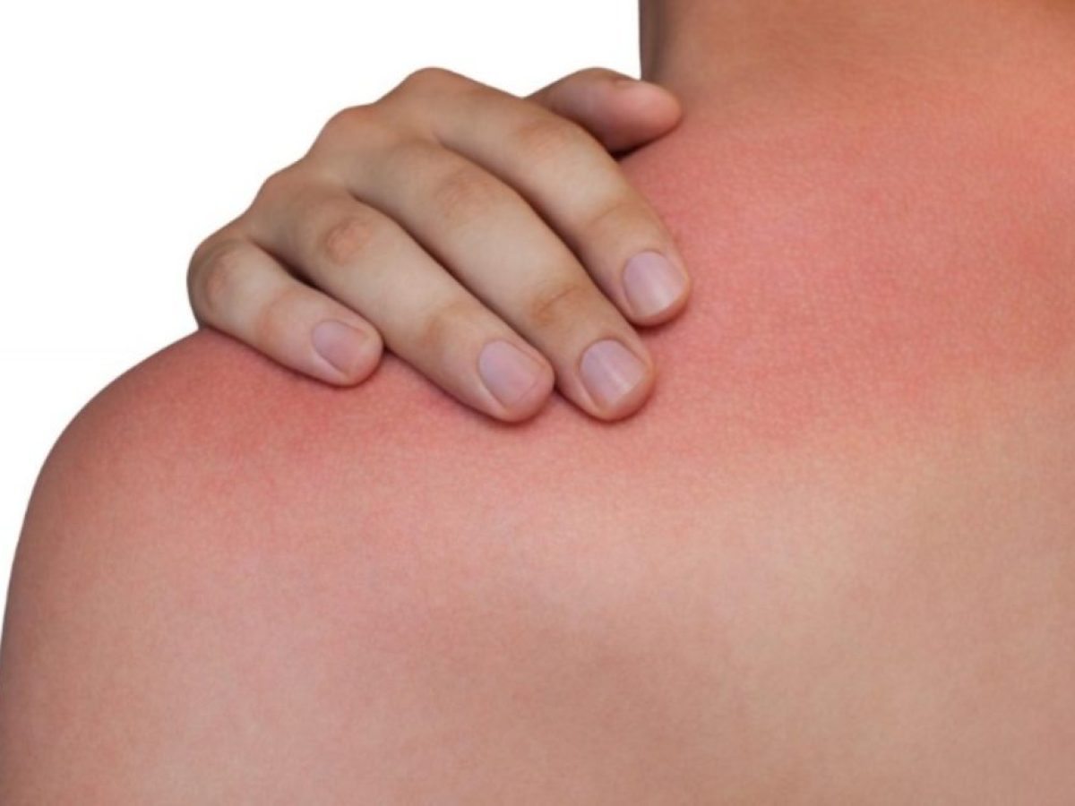 Καρκίνος του δέρματος: Πώς το ηλιακό έγκαυμα μπλοκάρει την φυσική άμυνα του οργανισμού