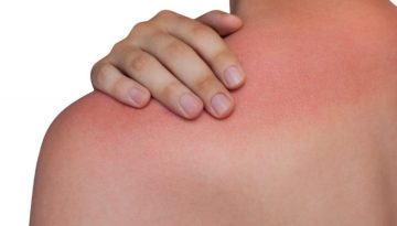 Καρκίνος του δέρματος: Πώς το ηλιακό έγκαυμα μπλοκάρει την φυσική άμυνα του οργανισμού