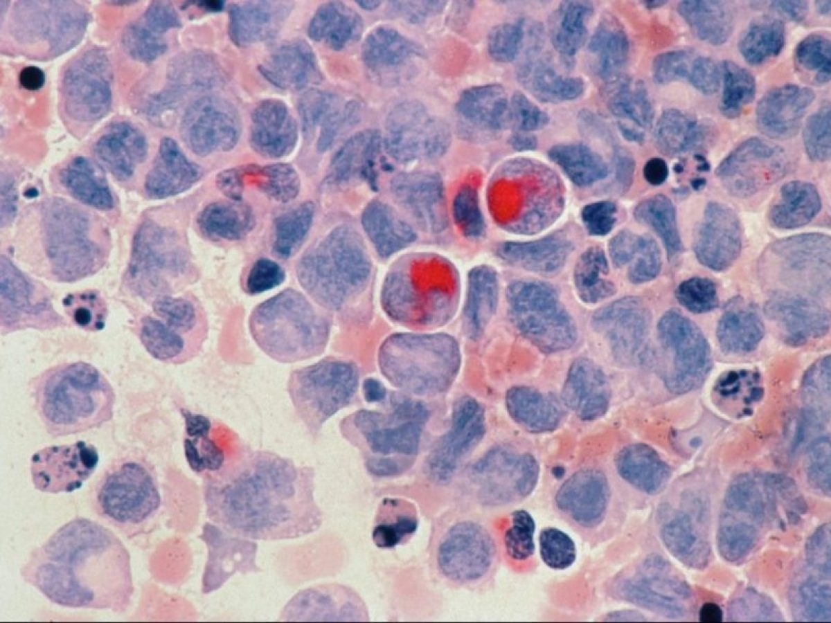 Πρόληψη καρκίνου: 4 στις 10 περιπτώσεις μπορούν να αποφευχθούν – Τι δείχνουν τα στοιχεία