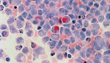 Πρόληψη καρκίνου: 4 στις 10 περιπτώσεις μπορούν να αποφευχθούν – Τι δείχνουν τα στοιχεία