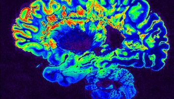 Σκλήρυνση κατά πλάκας: Μπορεί να ξεκινά πάνω από 10 χρόνια πριν τα συμπτώματα