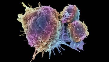 Καρκίνος: Βρήκαν γονίδιο που τον εξολοθρεύει – Προοπτικές για νέα φάρμακα