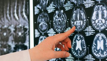 Η επιστήμη επιβεβαιώνει: Νέα εξέταση εντοπίζει την άνοια χρόνια πριν εμφανιστούν συμπτώματα