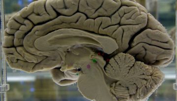 Η σημασία της βιταμίνης D για την άνοια και το Αλτσχάιμερ